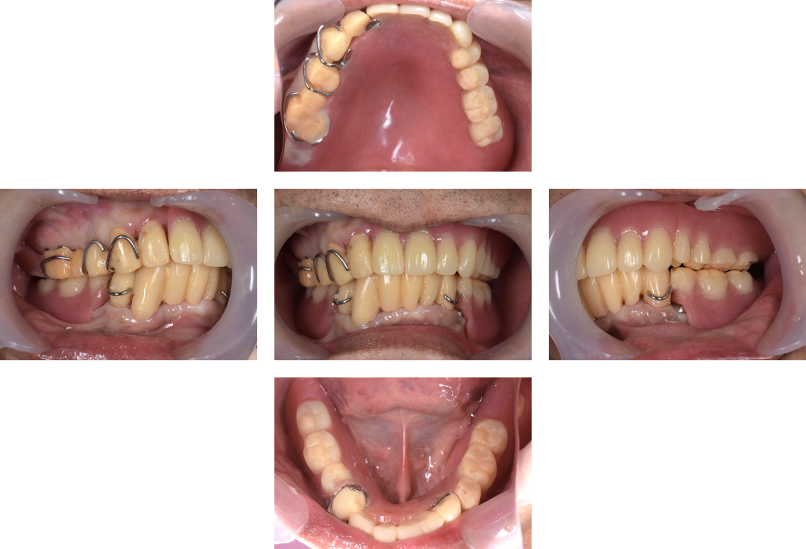 CASE04 インプラントを戦略的に利用し咬合再構成を行った症例 | 秋津の