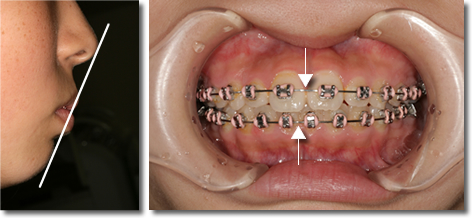 NGな矯正治療：転医症例Case3｜三重県伊賀市、木津川市のアイウエオ