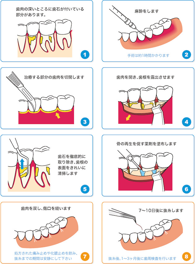 歯周組織再生療法 | 板東歯科医院南昭和オフィス