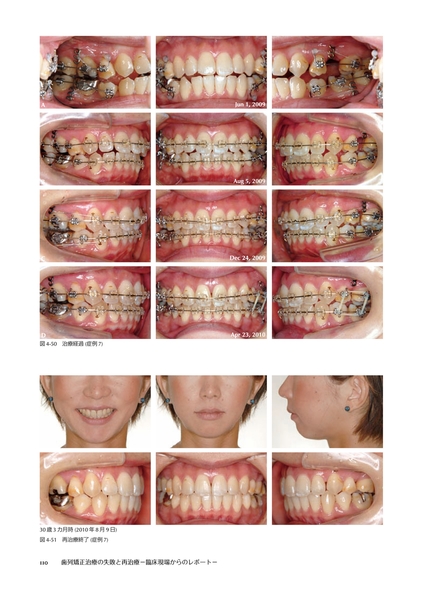 歯列矯正治療の失敗と再治療