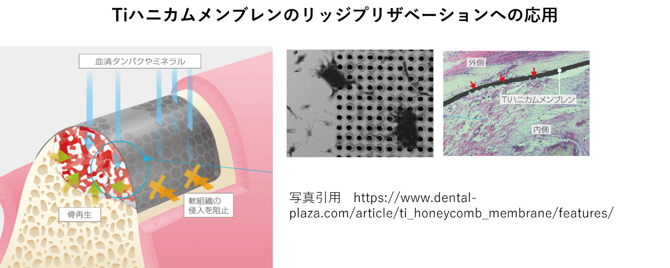 リッジ（ソケット）プリザベーションが大切である理由リッジ（ソケット