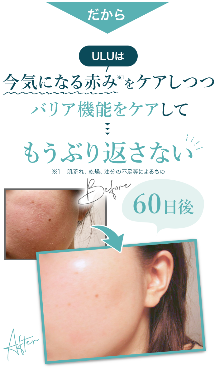 ULU FREE（ウルウフリー）シェイクモイストミルク／赤ら顔・酒さの治し