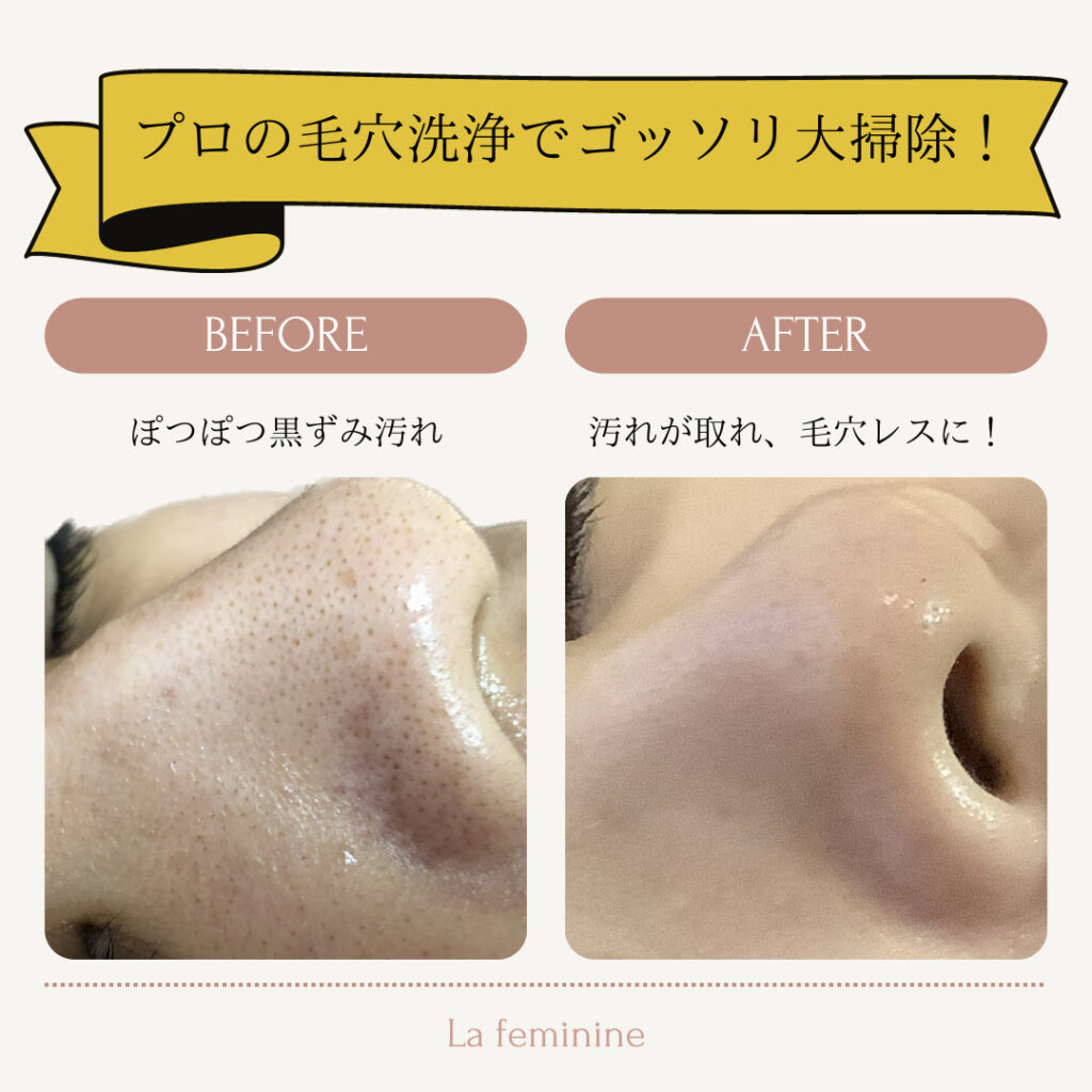 すっごいゴッソリ！毛穴洗浄キャンペーン | 滋賀県甲賀市水口のエステ