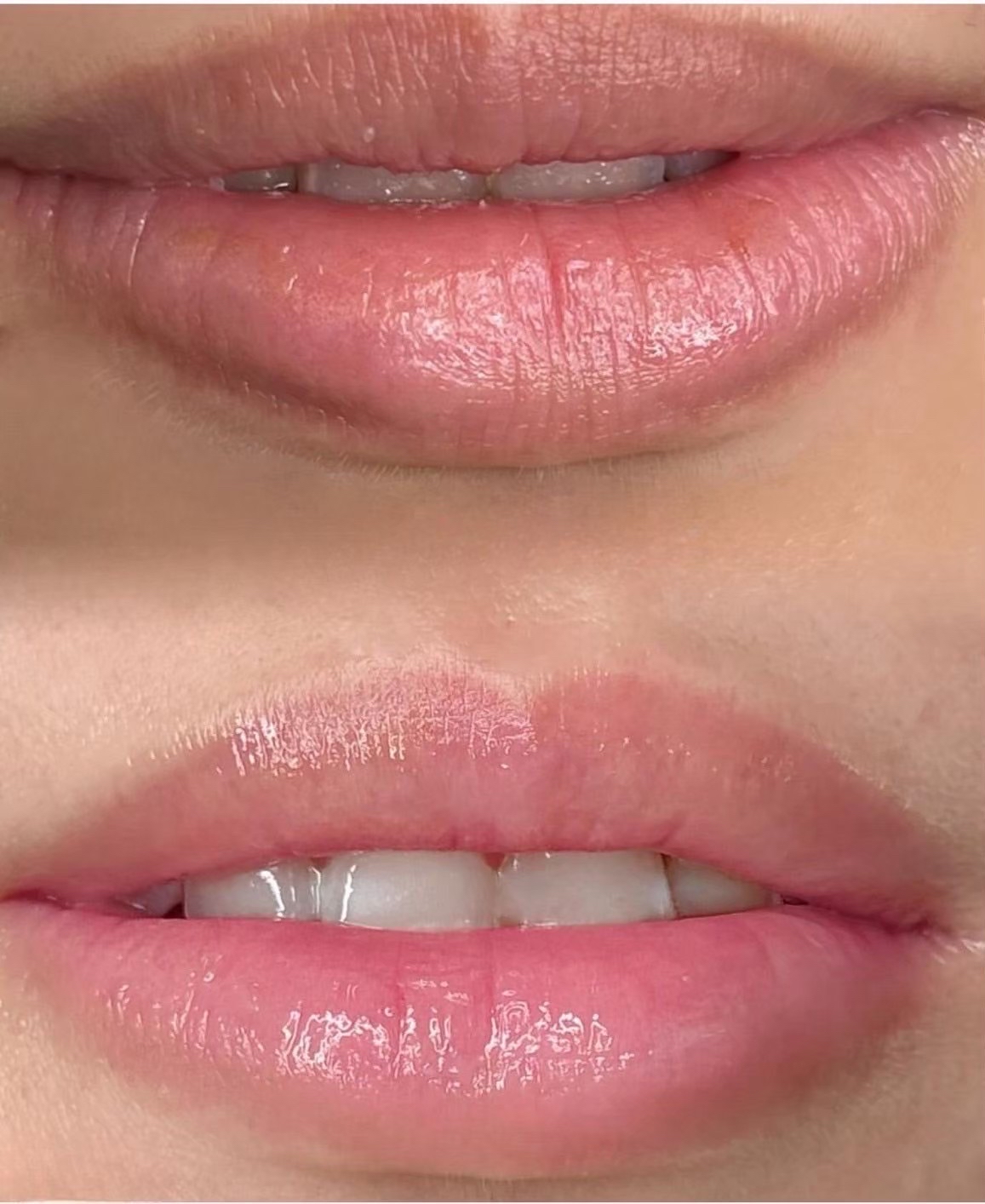 ローマピンク（Roma Pink）｜美容皮膚科エルムクリニック