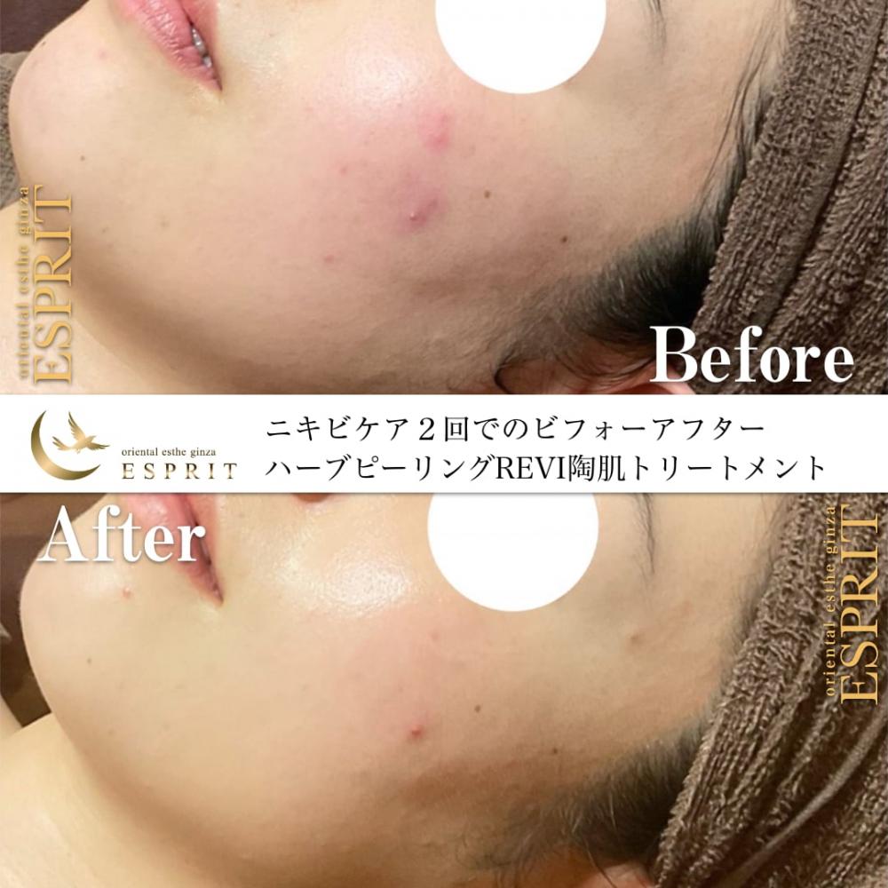 ハーブピーリングREVI【ルヴィ】陶肌トリートメント ｜東京銀座、新宿