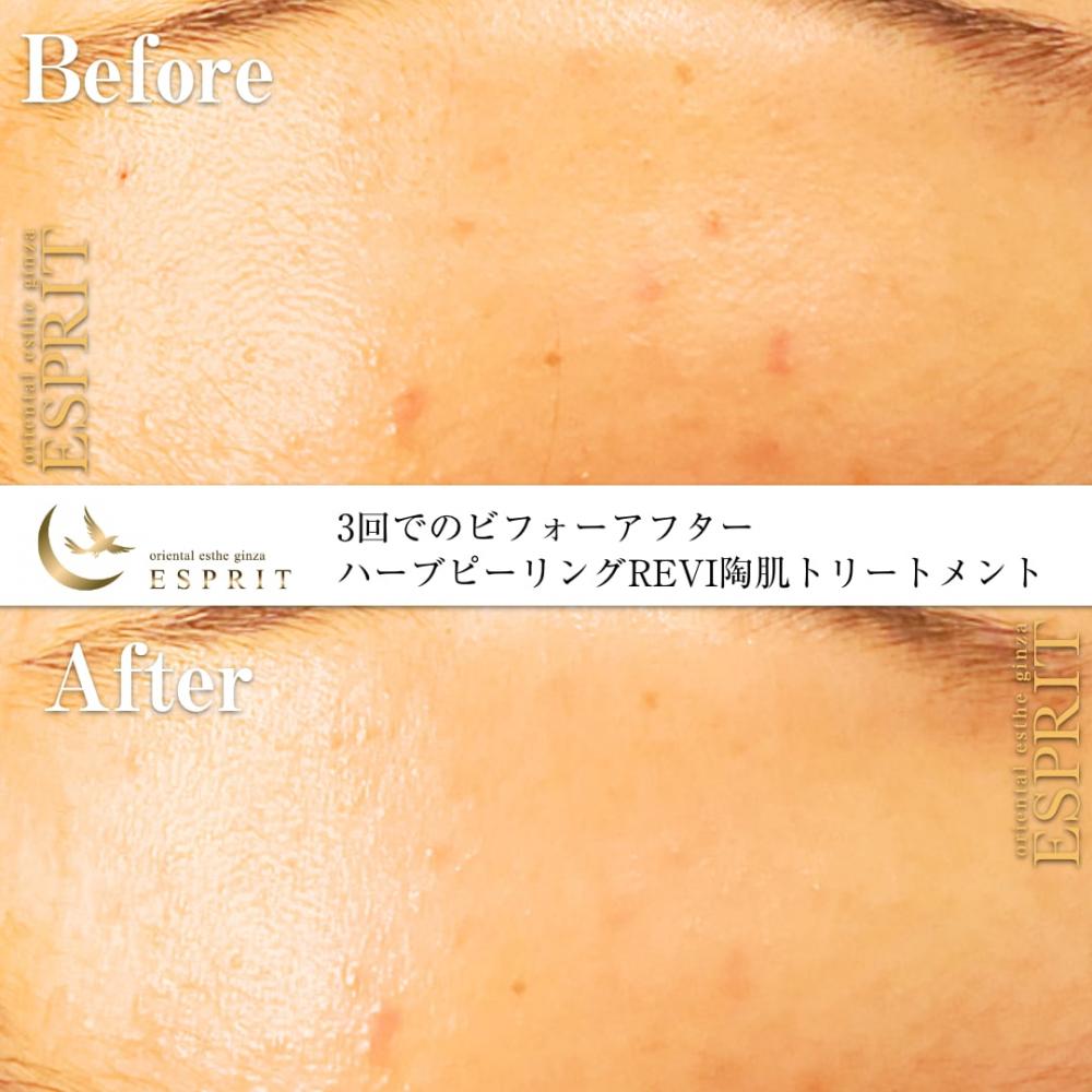 ハーブピーリングREVI【ルヴィ】陶肌トリートメント ｜東京銀座、新宿