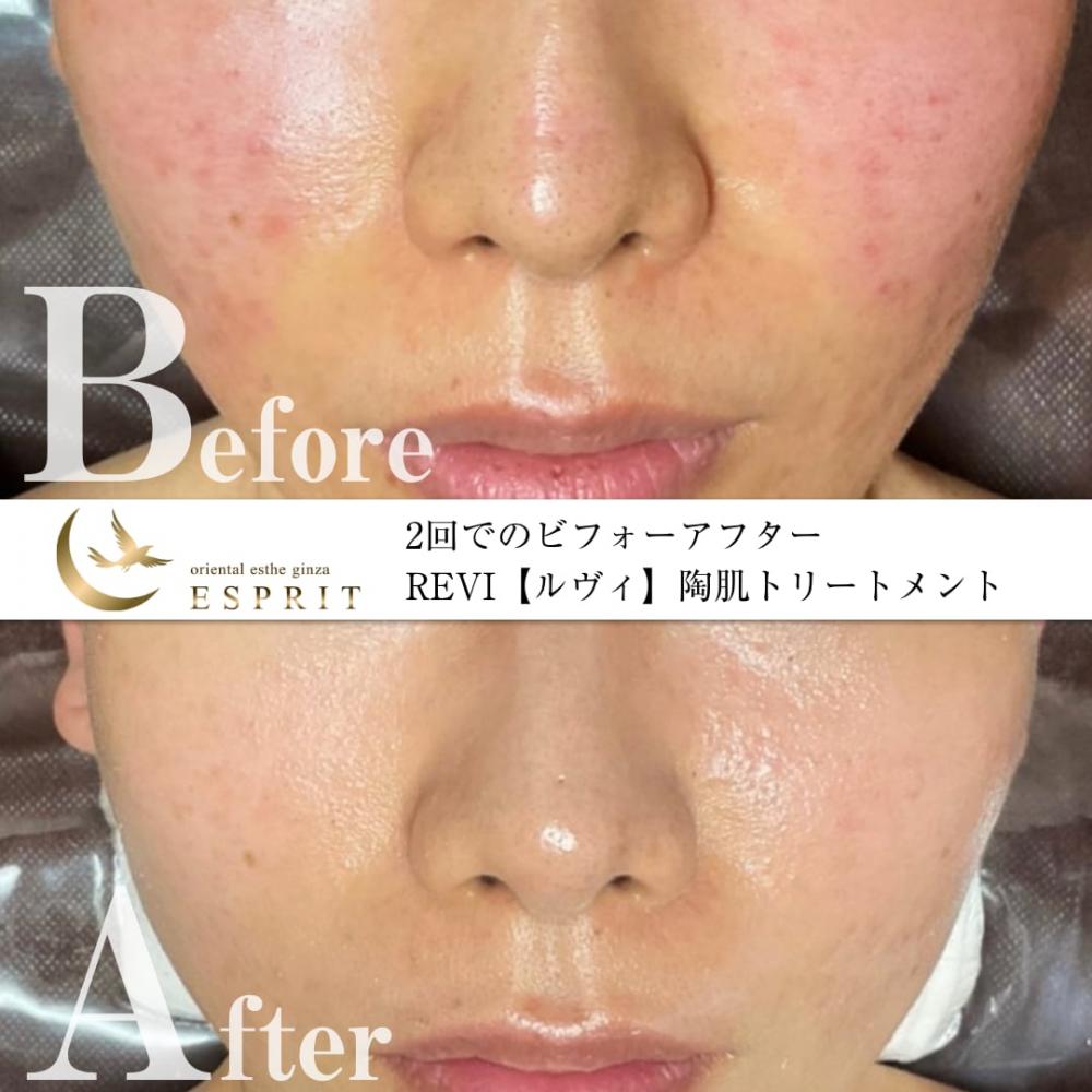 ハーブピーリングREVI【ルヴィ】陶肌トリートメント ｜東京銀座、新宿