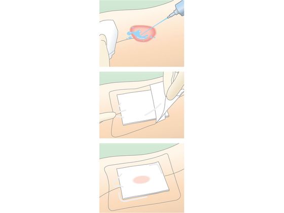 アルケア デルマエイド 8号 100枚入 11985 通販【フォレストウェイ】