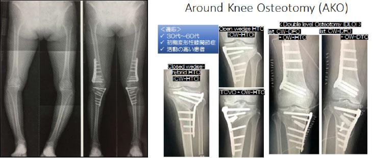 膝関節の疾患と手術：整形外科の専門手術 人工関節手術・関節鏡視下