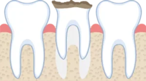 抜歯後すぐ骨を守る】ソケットプリザベーションとは？骨吸収予防・流れ