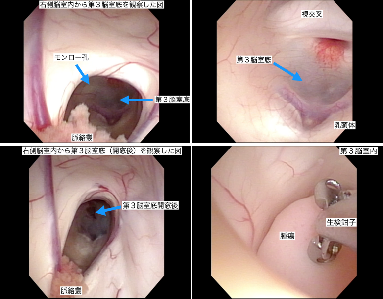 神経内視鏡手術 ｜ 藤田医科大学 医学部 脳神経外科学講座