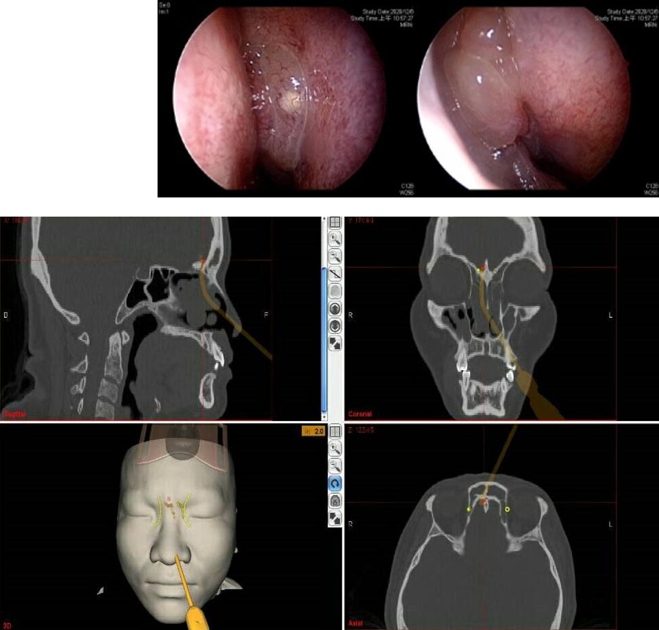 高雄市醫療觀光網---耳鼻咽喉科副鼻腔ナビゲーション手術 プレスリリース