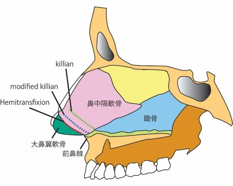大阪の鼻中隔弯曲症の手術なら北東大阪耳鼻咽喉科 鼻・副鼻腔手術