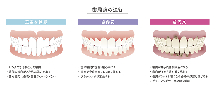 歯周病で失われた歯周組織の再生治療とは？治療別のメリットを解説し