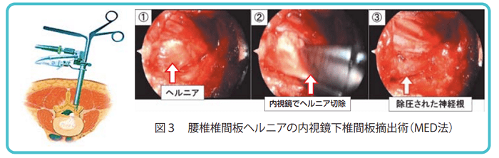 脊椎の内視鏡手術① | 関西ろうさい病院（兵庫県尼崎市）地域医療支援