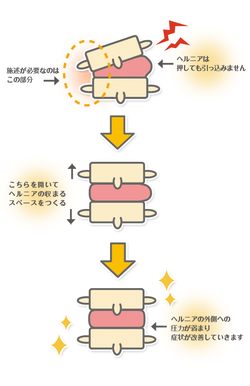 頚椎椎間板ヘルニア改善オリジナルメソッド | 大阪府池田市の整体院