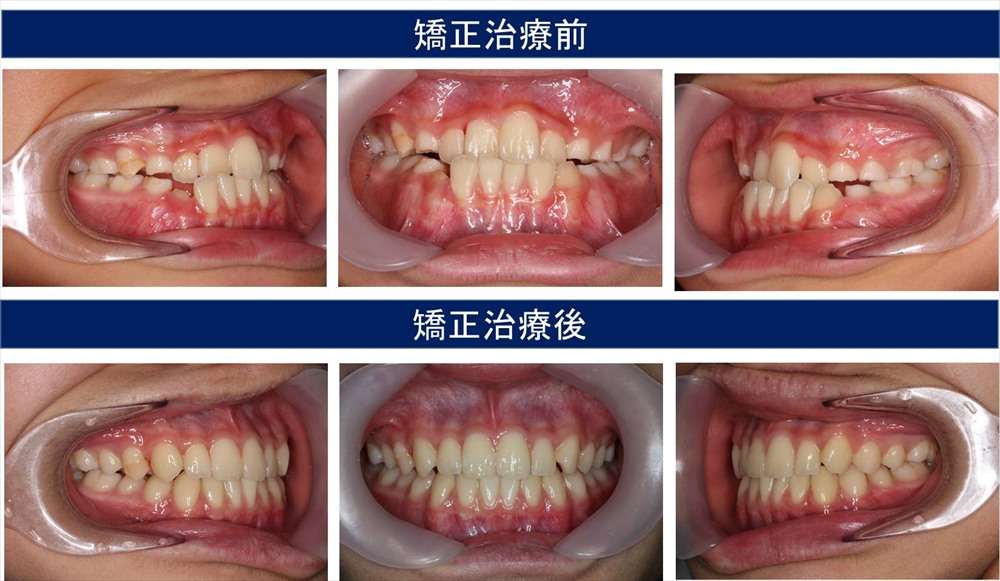 反対咬合の歯科矯正治療例 | 千葉県柏市で歯列矯正なら柏KT矯正歯科