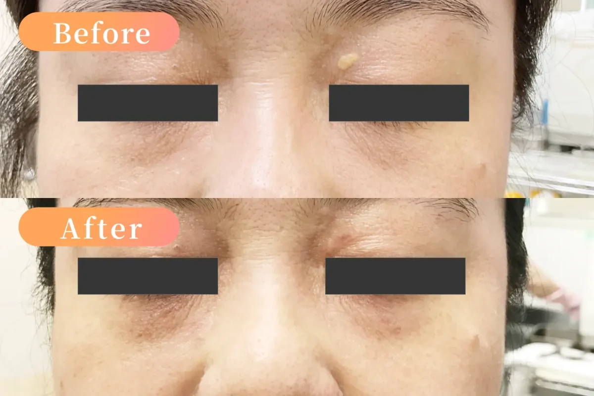 症例紹介 アーカイブ | 足立区 北綾瀬皮膚科【公式】 一般皮膚科 皮膚