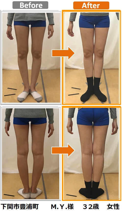 O脚矯正 | 下関市菊川町の整体｜菊川カイロプラクティック院 肩こり