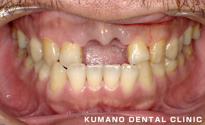 前歯部審美治療の症例01 - くまの歯科