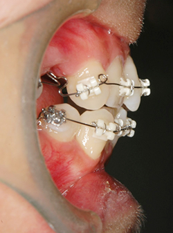 矯正治療実況中継 第2回 | 星歯科矯正【神奈川県相模原市の矯正歯科】