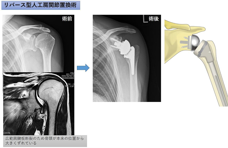 リバース型人工肩関節置換術（RSA） – 三田市民病院