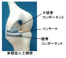第18回 『人工膝単顆置換術＝UKAとは』｜関節の広場 -いつまでも、歩き