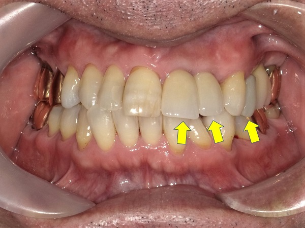 上顎多数歯欠損インプラント症例｜症例解説｜東京銀座シンタニ