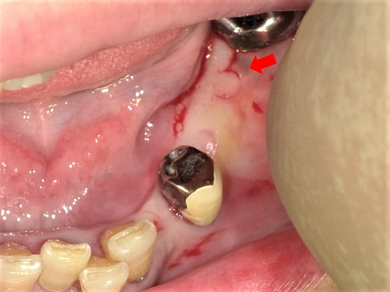 下顎多数歯欠損インプラント症例｜症例解説｜東京銀座シンタニ