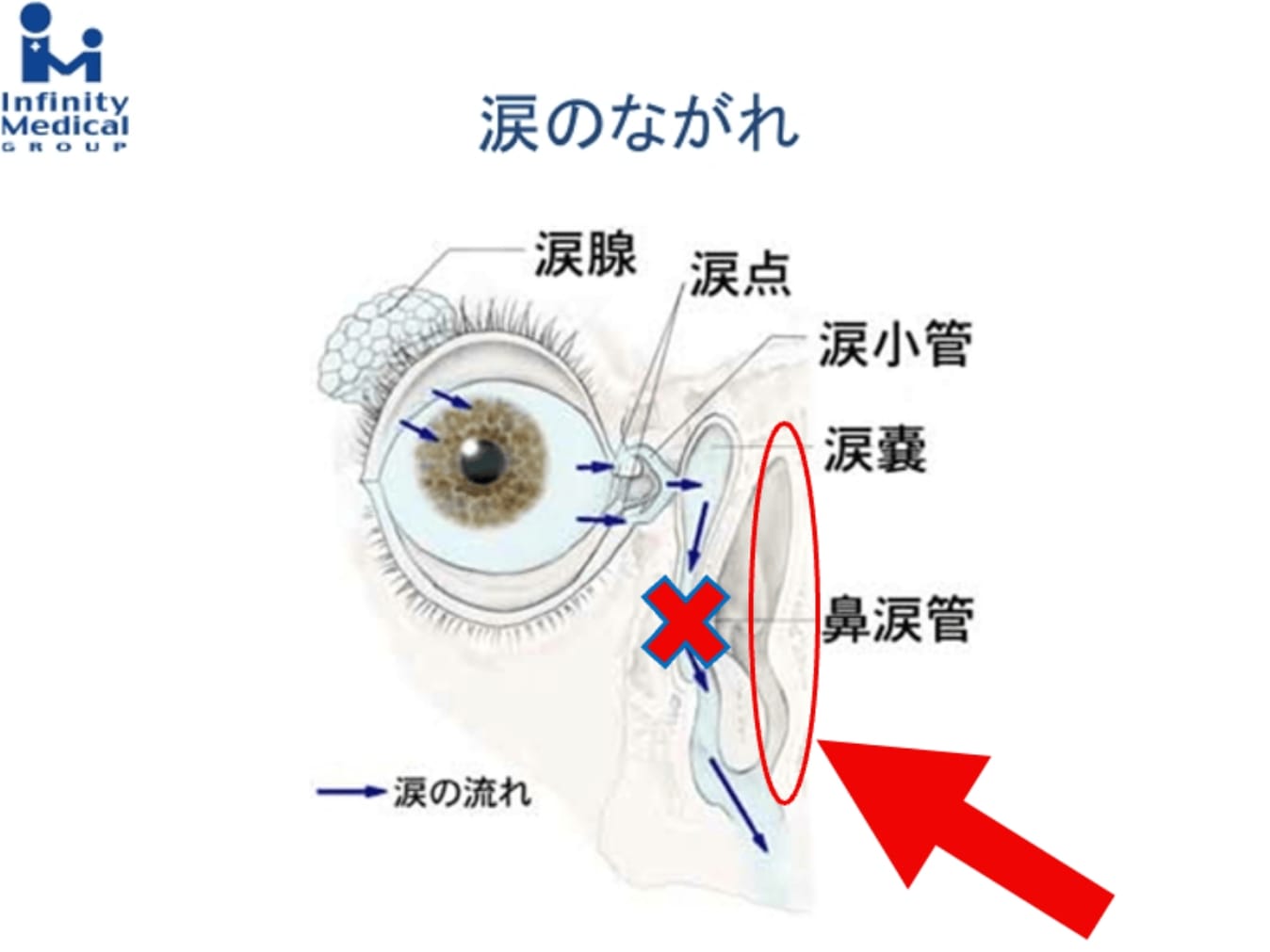 涙目（なみだ目）の手術治療（涙道の閉塞など）｜なみだ｜東京都