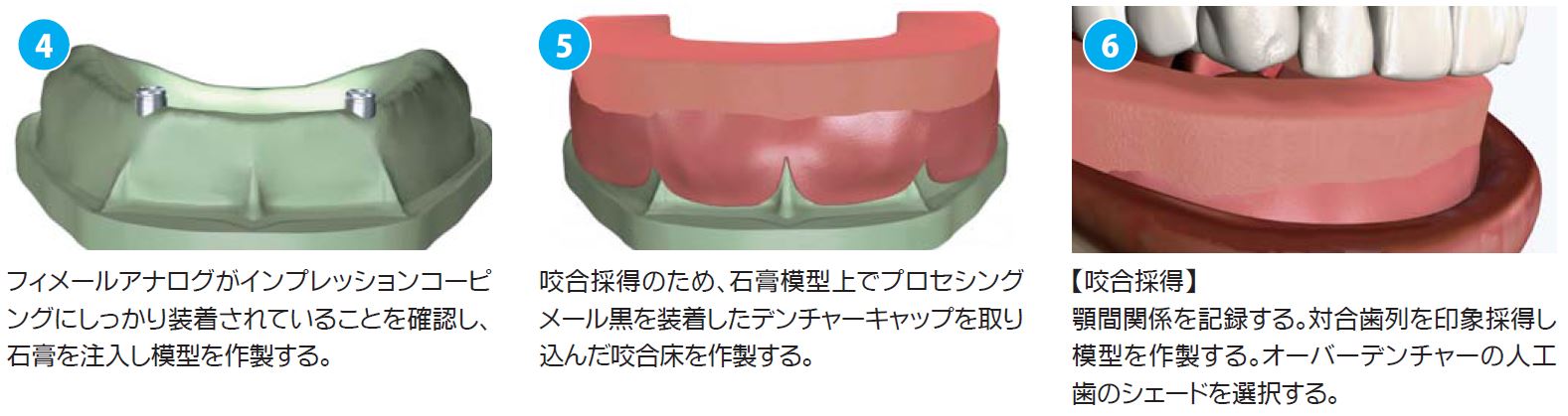 アバットメント(ロケーター）|株式会社インプラテックス