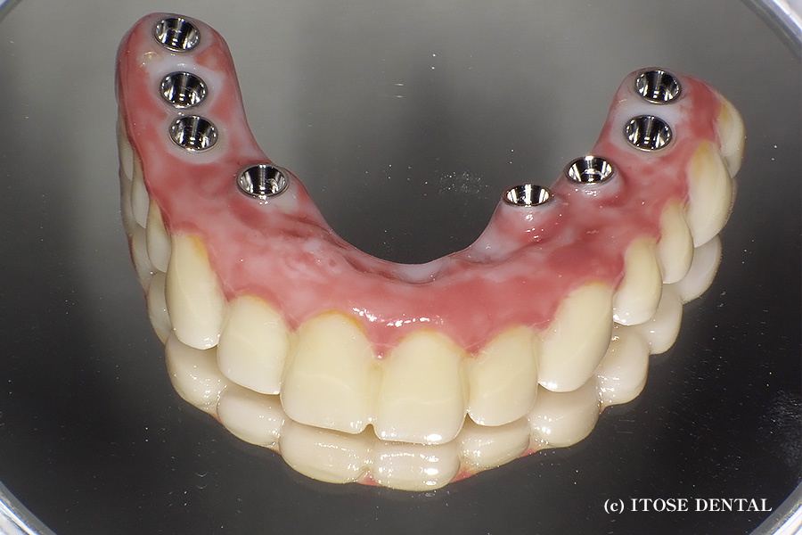 全体的なインプラント補綴治療 - 大分インプラント新港イトセ歯科大分