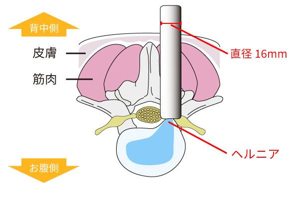 MED：椎間板ヘルニアの内視鏡下手術｜岩井整形外科病院