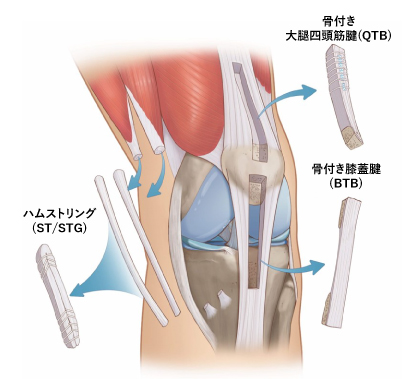 膝前十字靭帯損傷｜稲波脊椎・関節病院