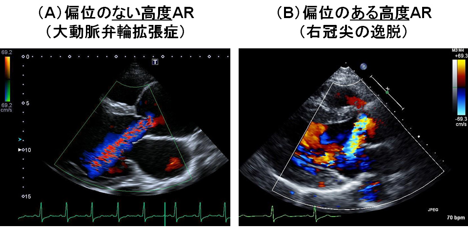 治療方針を決める大動脈弁逆流の心エコー | 「心臓」特別号「弁膜症