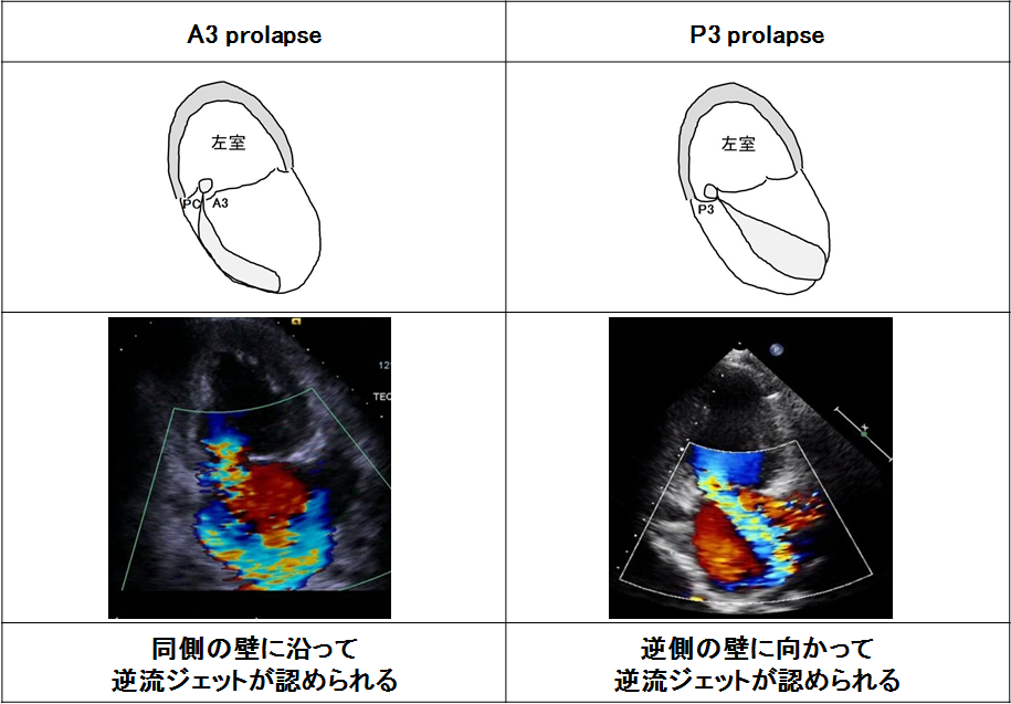 心エコーによる僧帽弁逆流の重症度評価と問題点 | 「心臓」特別号「僧