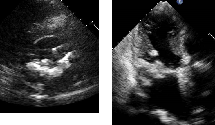 心エコーによる僧帽弁狭窄の重症度評価と問題点 | 「心臓」特別号「僧