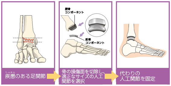 人工足関節置換術とは｜人工足関節について｜人工関節とは｜人工関節