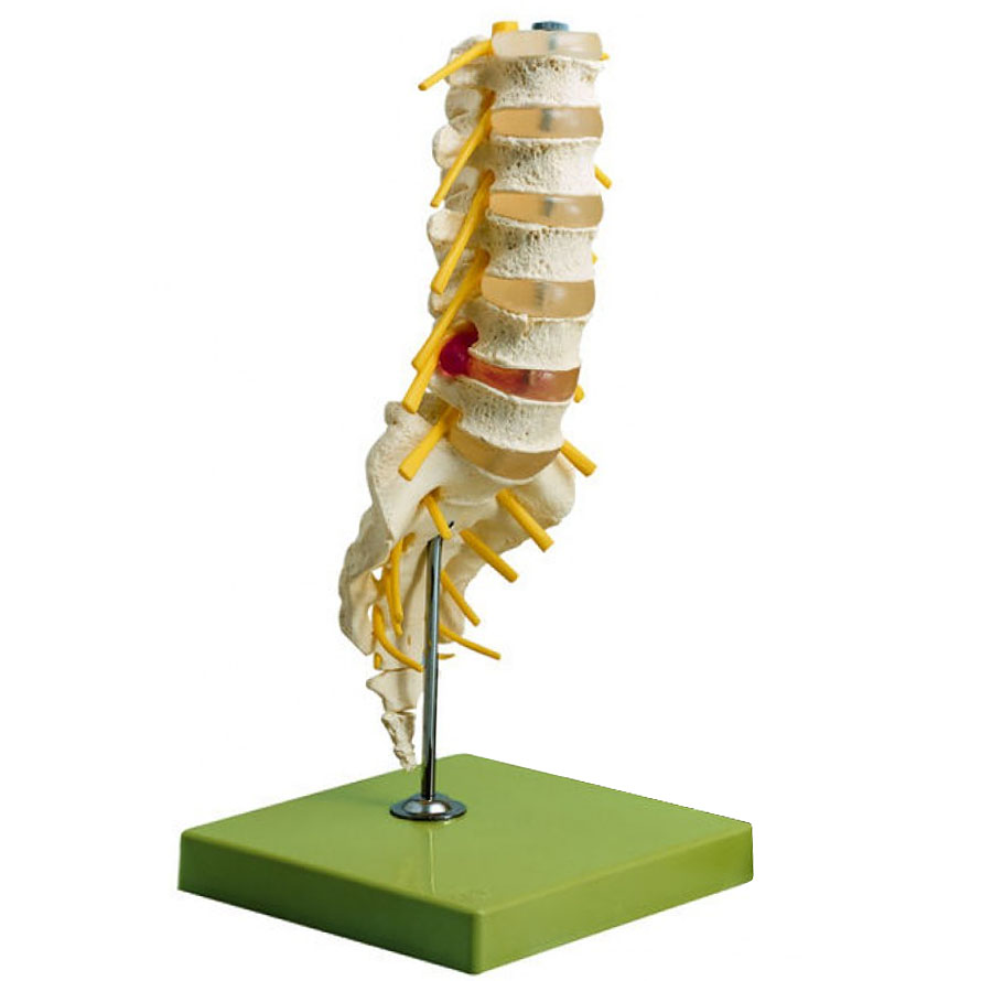 人体模型 腰椎模型/ヘルニア/分離症・すべり症付 ソムソ社