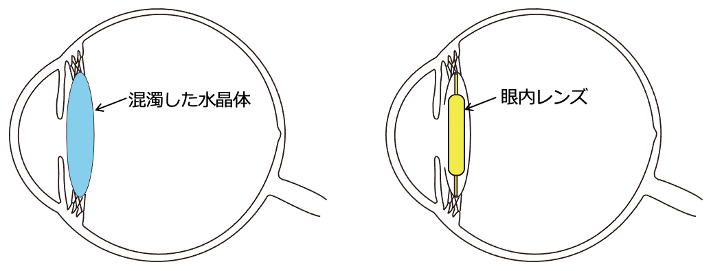 眼内レンズ | 日本人工臓器学会