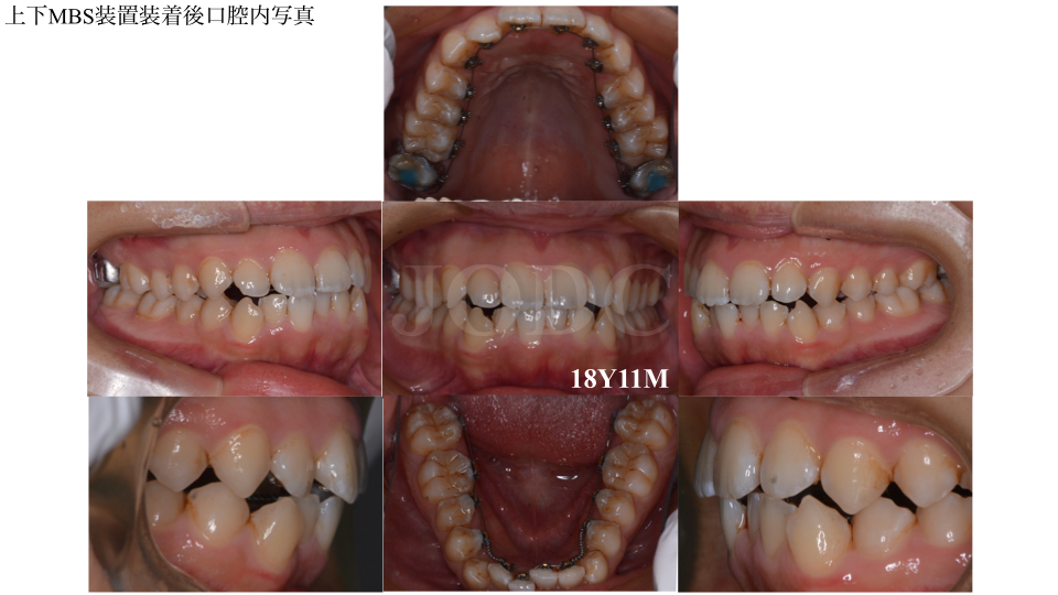 フルリンガルブラケット矯正装置(セルフライゲーションリンガル)10代