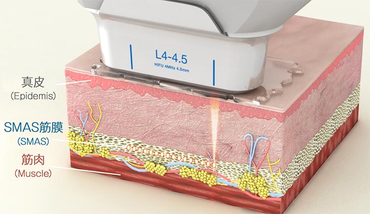 HIFU｜ハイフ｜美容医療｜桑原皮フ科クリニック