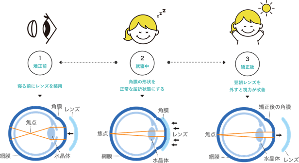 近視進行抑制治療 | 【公式】小川眼科｜京王聖蹟桜ケ丘東口より徒歩1分