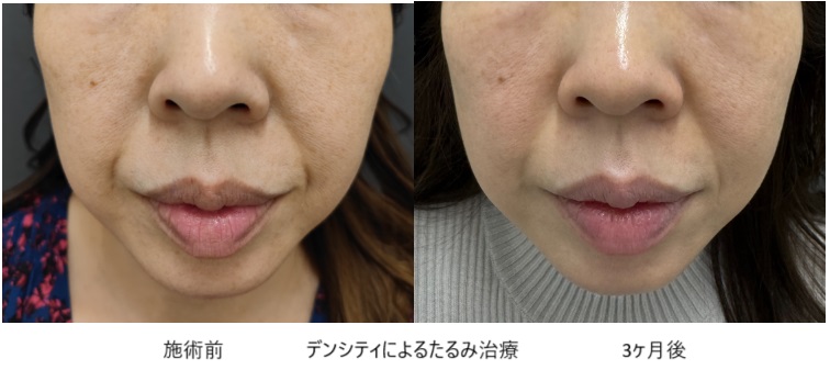 ほうれい線形状による分類とその対処方法について