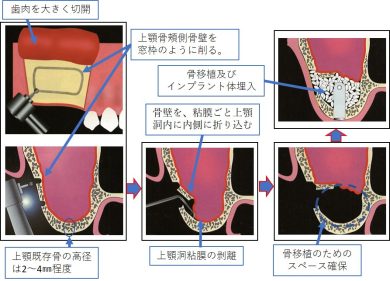 上顎のインプラント第二弾 上顎洞底挙上術について ｜ 森岡歯科医院