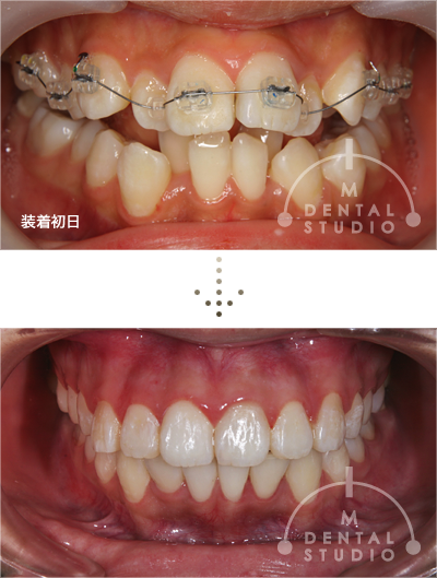 出っ歯・乱ぐい】成長期すぎての非抜歯矯正技術 - 治療実績集 | 矯正