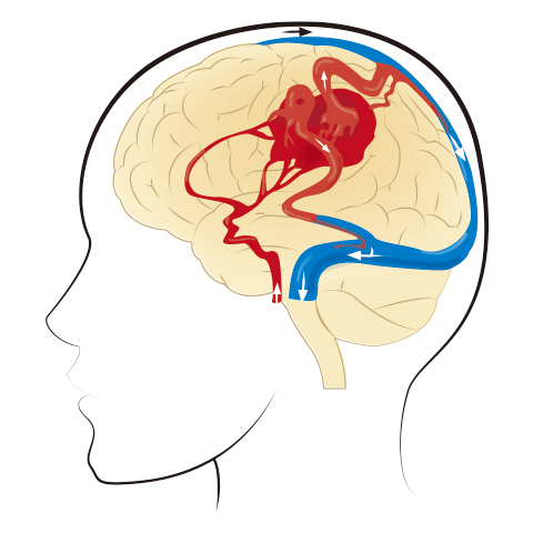 裁断済】dAVF・AVM (脳動静脈奇形) のすべて dAVF・AVM（硬膜動静脈瘻
