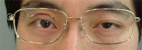 眼瞼下垂矯正メガネ～メガネの一心堂