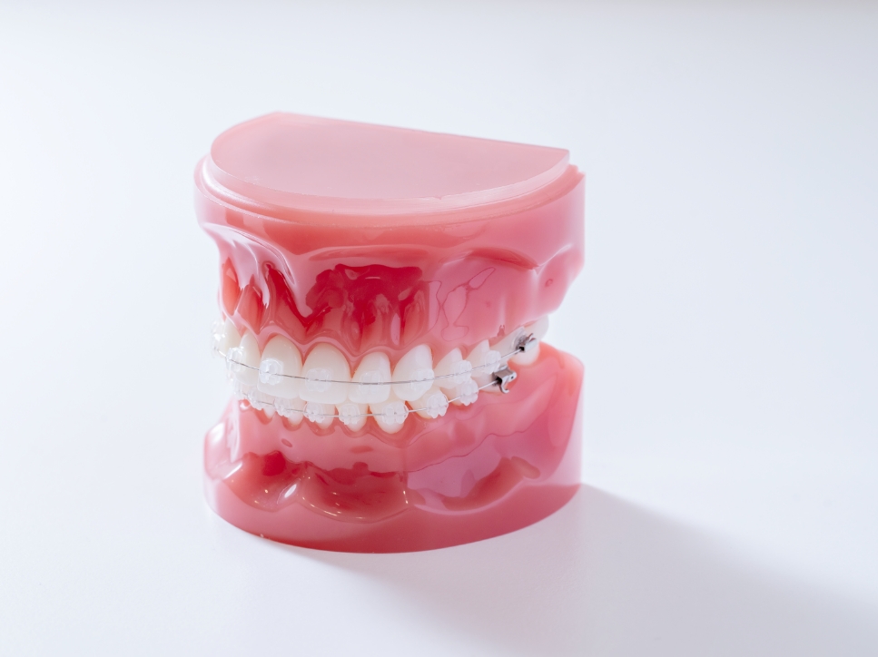 矯正装置について | 幕張ベイタウン矯正歯科