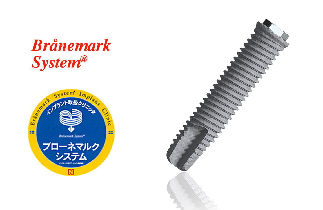 インプラント | 宮本歯科【公式】銀座駅徒歩1分、有楽町駅徒歩3分